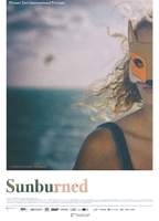SUNBURNED